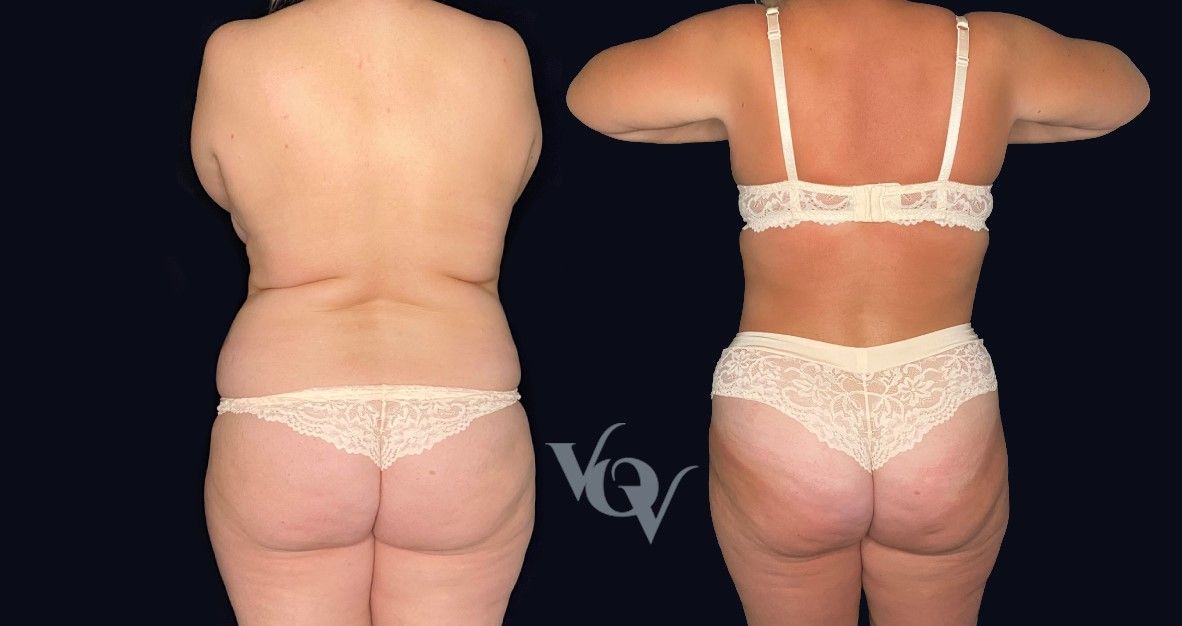 Липосакция спины. 4 месяца после операции