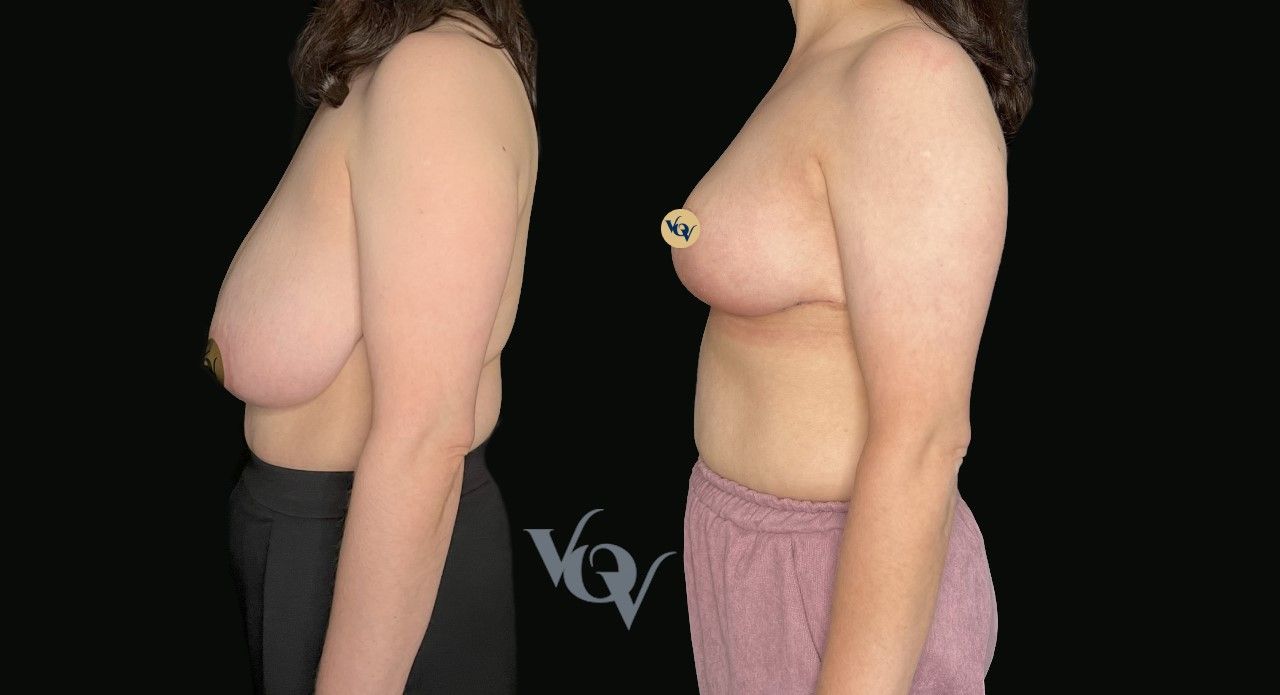 Уменьшение груди. 2 месяца после операции 