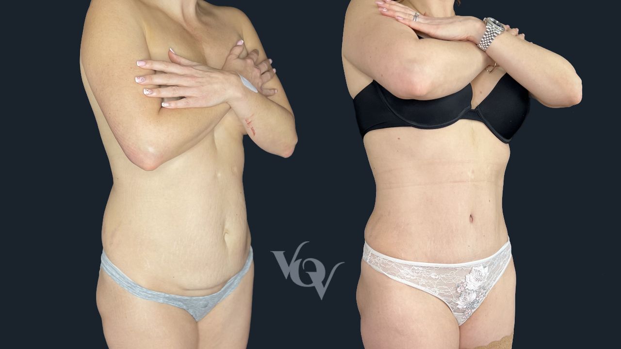 Абдоминопластика. 5 месяцев после операции