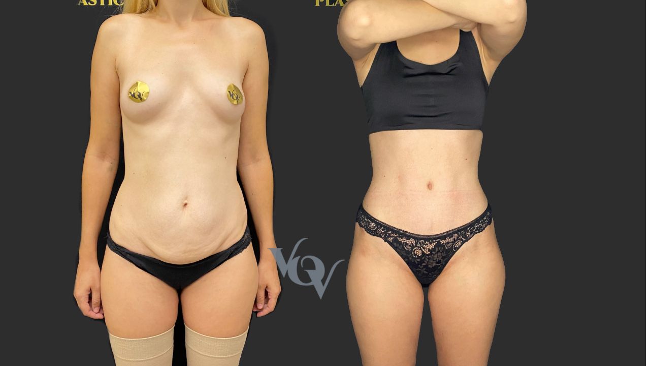 Абдоминопластика. 4 месяца после операции