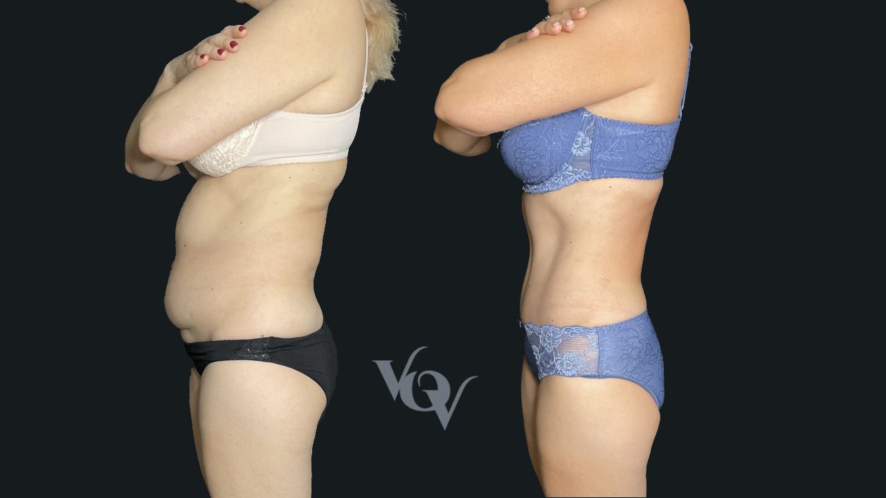 Абдоминопластика. 4 месяца после операции