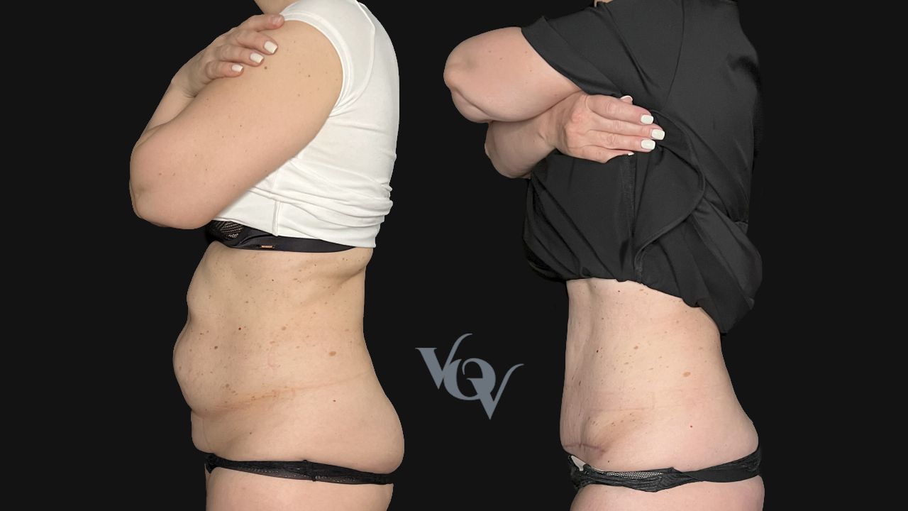 Абдоминопластика. 1.5 месяца после операции