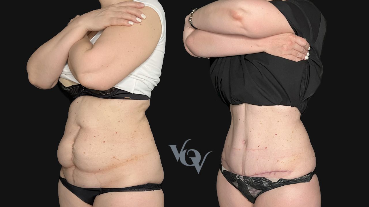 Абдоминопластика. 1.5 месяца после операции