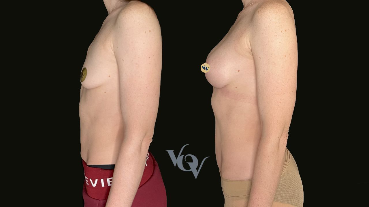 Замена имплантов. 2,5 месяца после операции