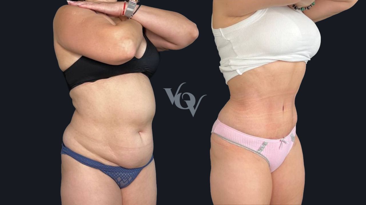 Абдоминопластика. 1 месяц после операции