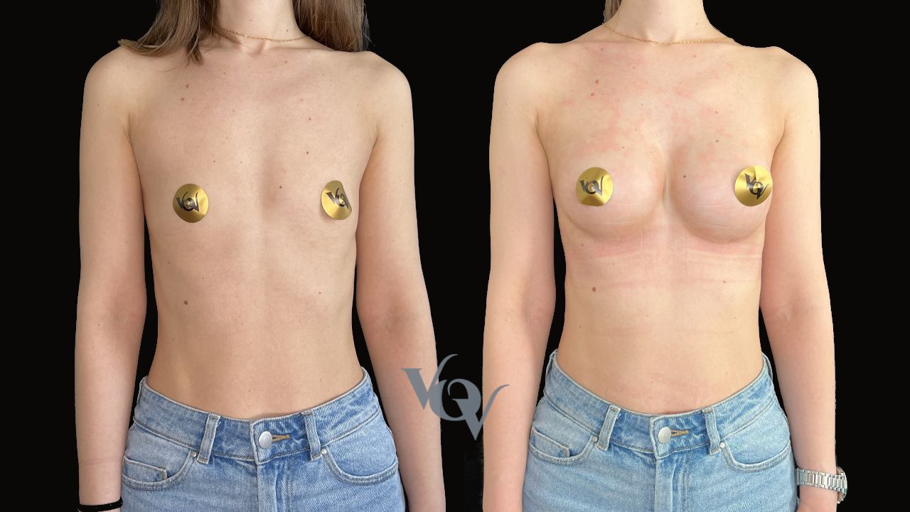 Замена имплантов. 3 месяца после операции