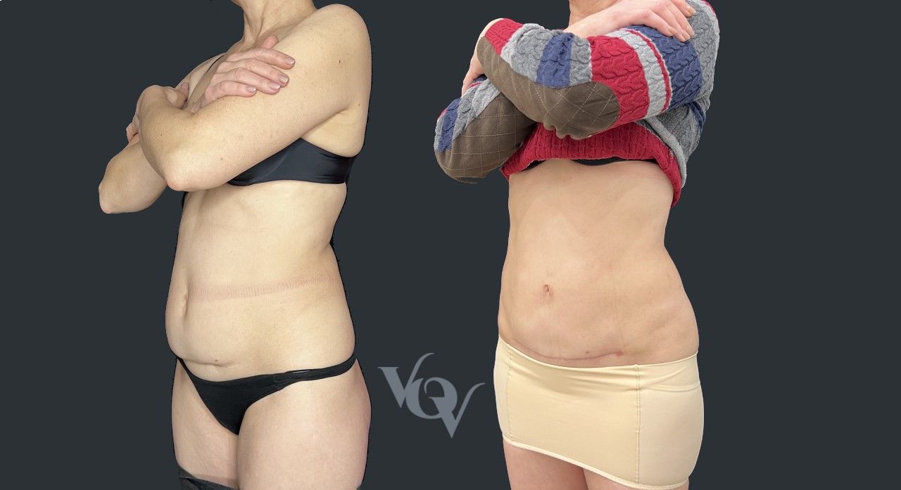 Миниабдоминопластика. 3 месяца после операции