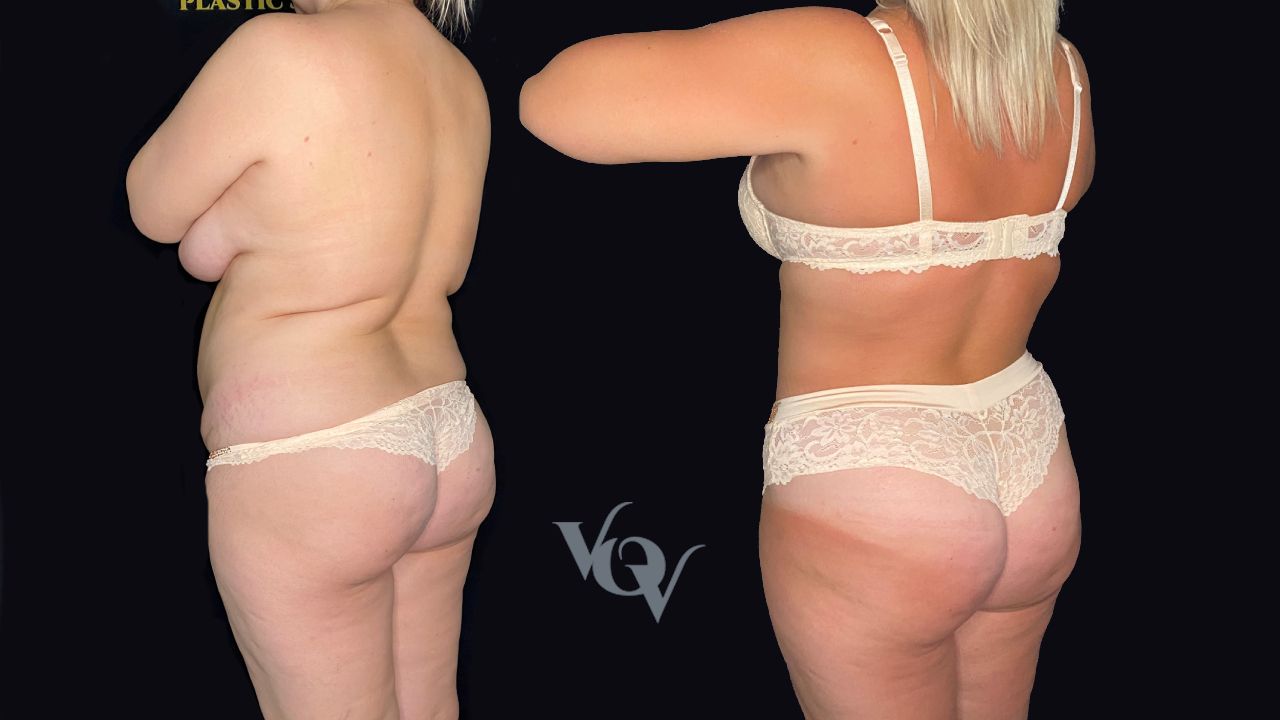 Липосакция спины. 4 месяца после операции