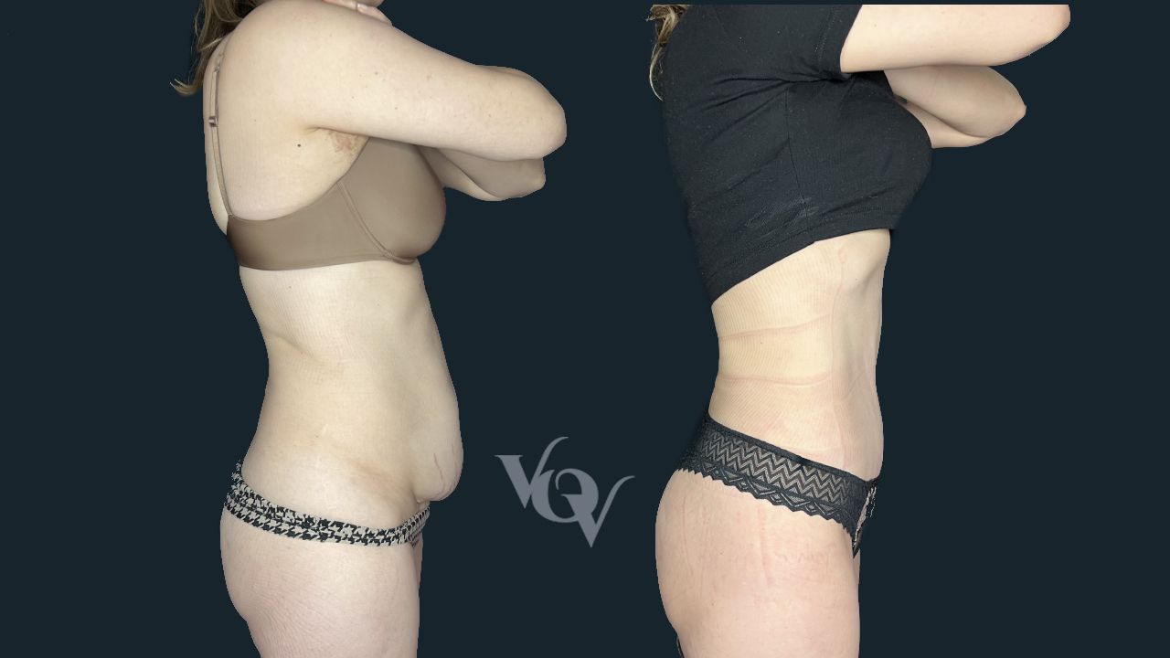 Абдоминопластика. 2 месяца после операции