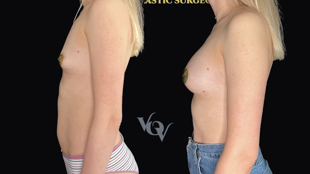 Замена имплантов. 3 месяца после операции