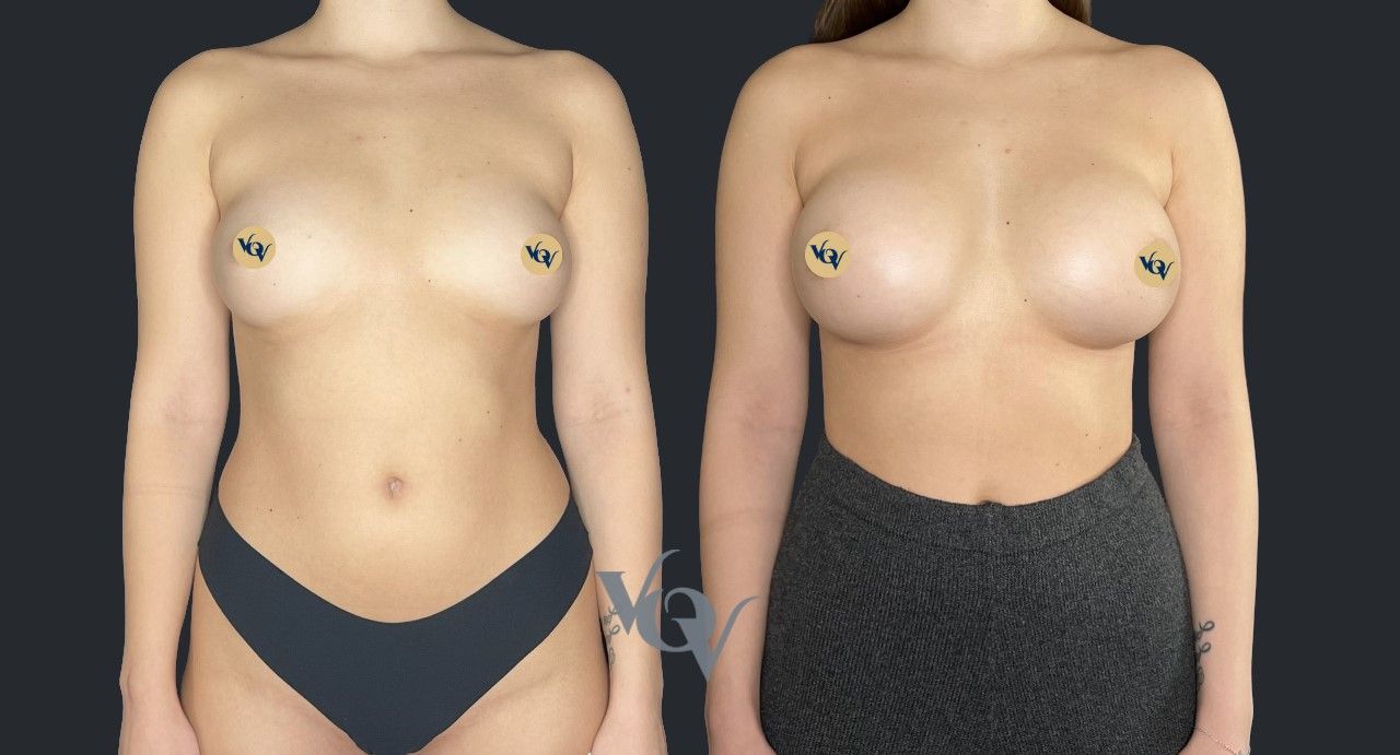 Замена имплантов. 2 месяца после операции