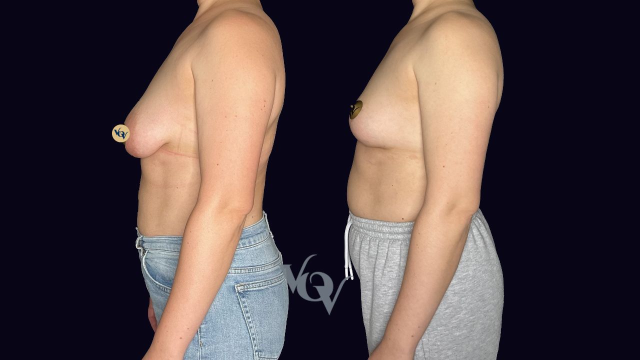 Коррекция тубулярности груди. 6 месяцев после операции 