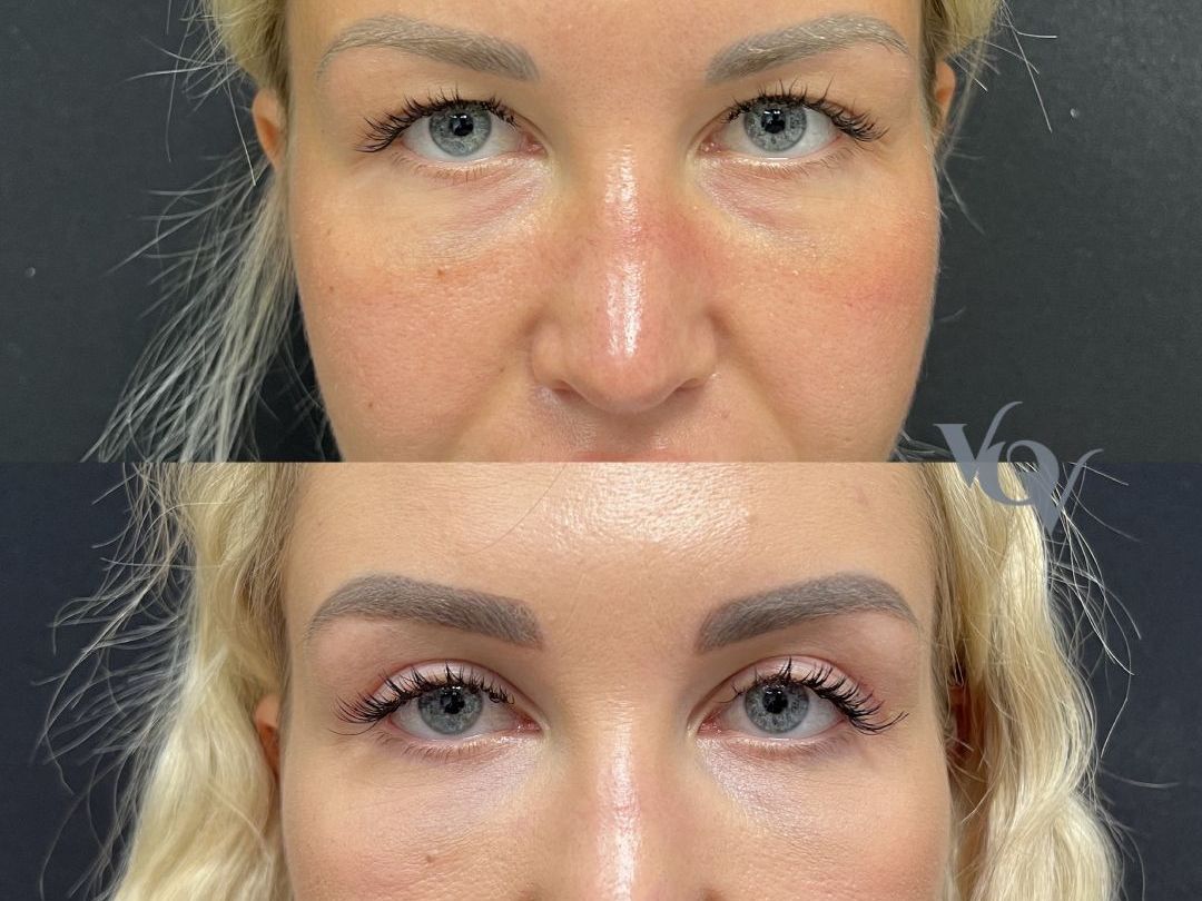 Верхняя блефаропластика. 1 месяц после операции