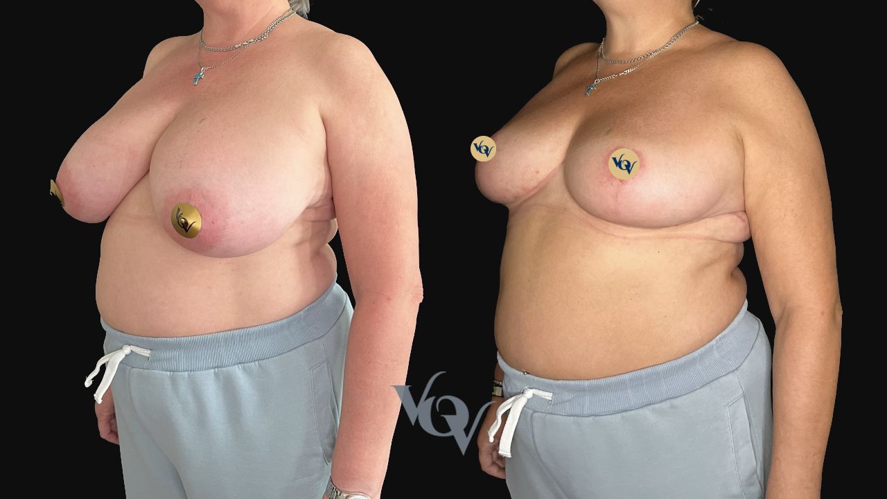 Уменьшение груди. 3 месяца после операции 