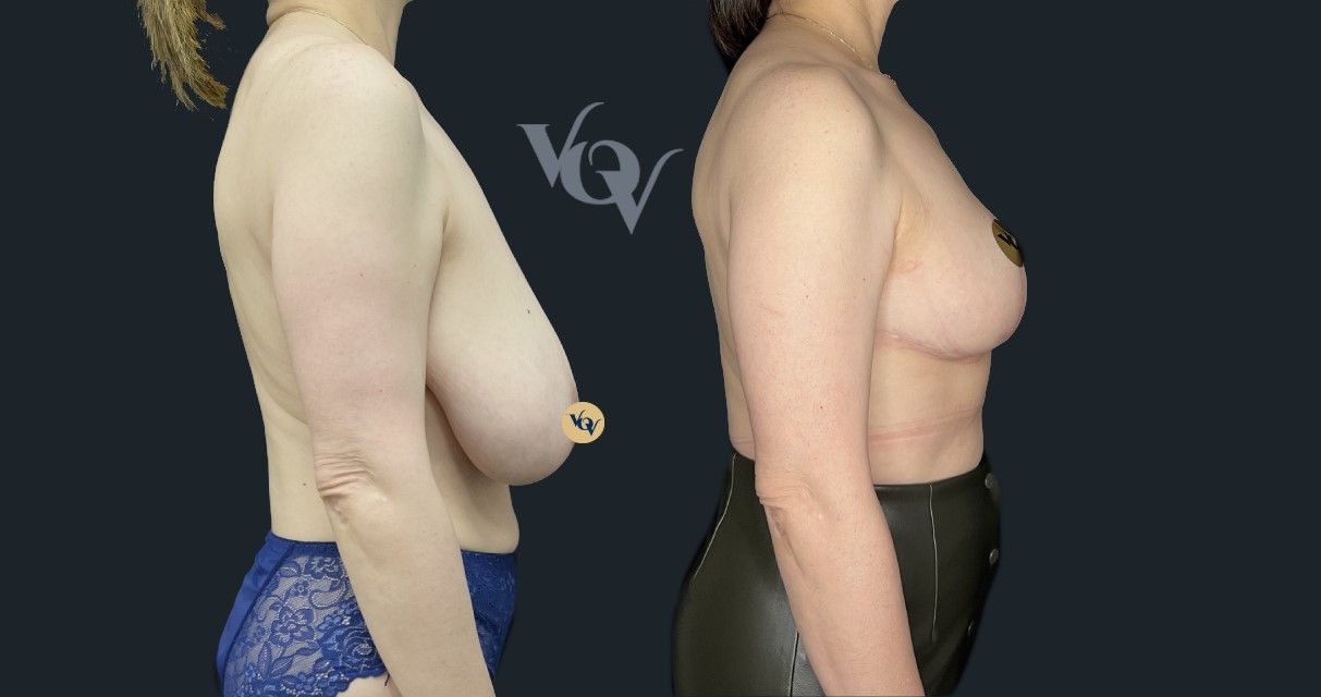 Уменьшение груди. 2 месяца после операции 