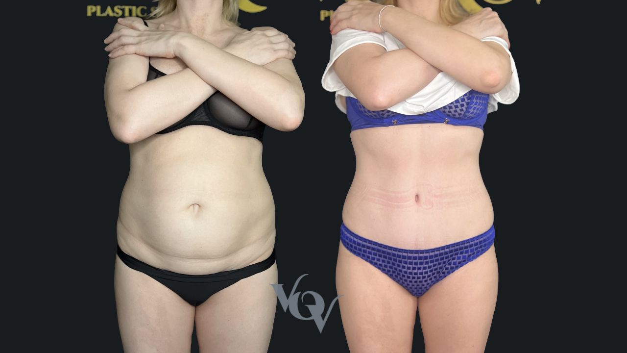 Абдоминопластика. 3 месяца после операции