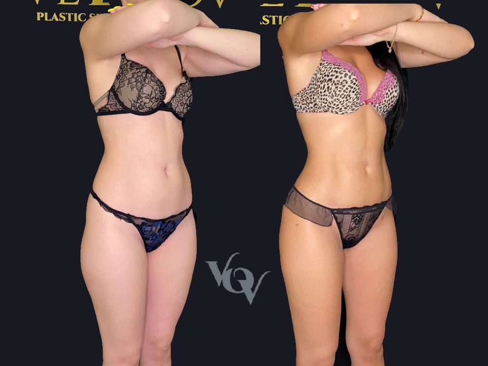 Липоскульптура живота с прорисовкой рельефа. 1 месяц после операции