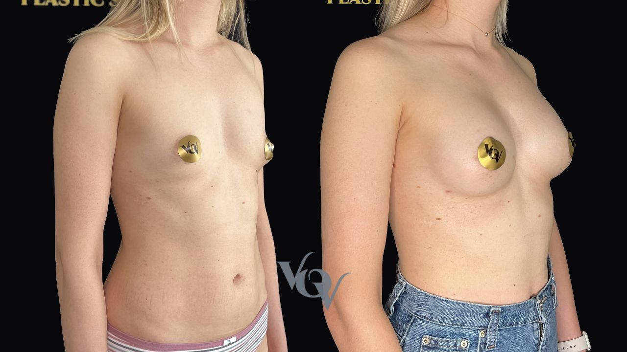 Замена имплантов. 3 месяца после операции