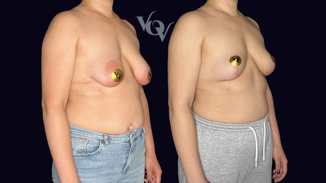 Коррекция тубулярности груди. 6 месяцев после операции 