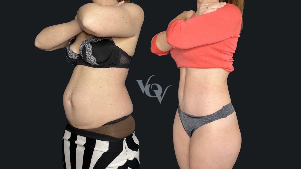 Абдоминопластика. 3 месяца после операции