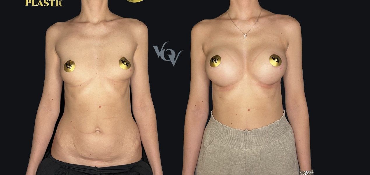 Замена имплантов. 1 месяц после операции