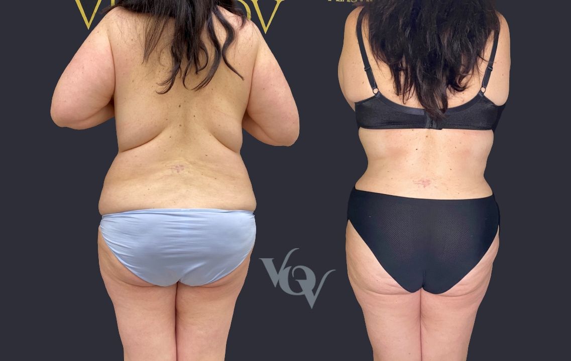 Липосакция спины. 2 месяца после операции