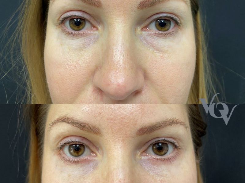 Нижняя блефаропластика. 2 месяца после операции