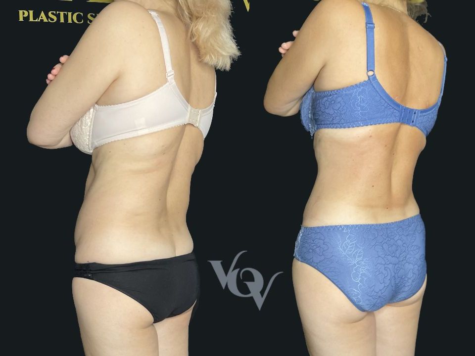 Липосакция спины. 4 месяца после операции