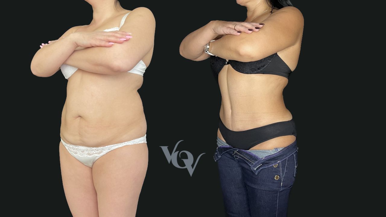 Абдоминопластика. 6 месяцев после операции