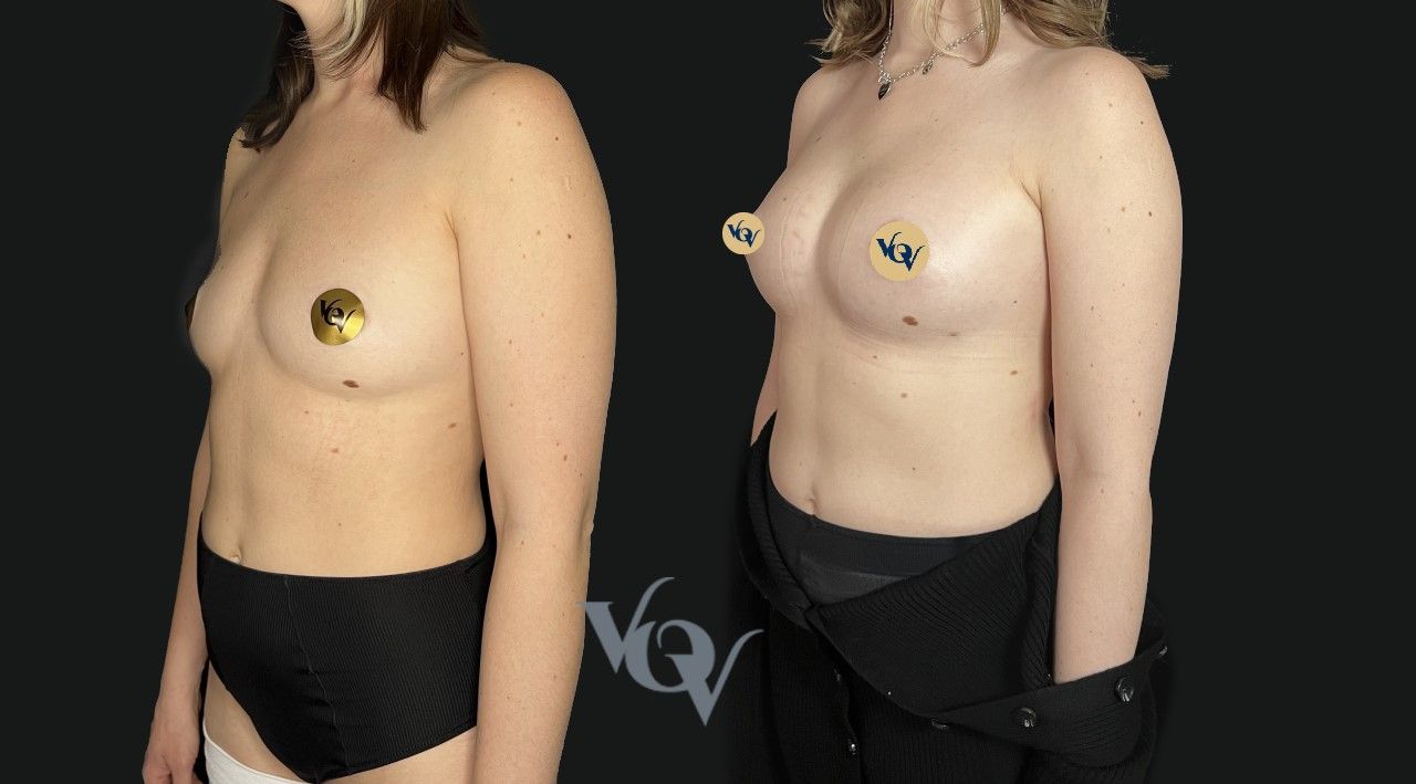 Замена имплантов. 1 месяц после операции