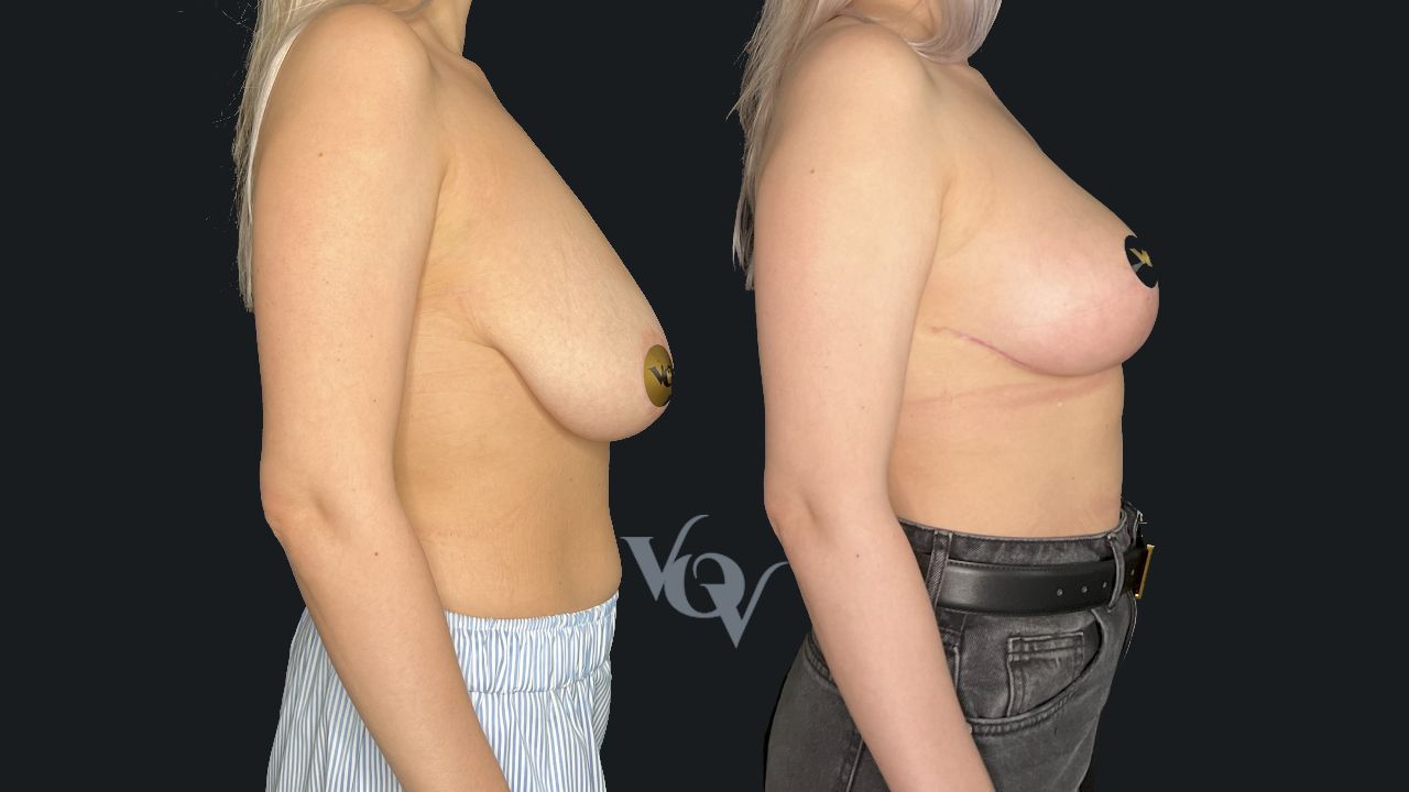 Подтяжка груди. 2 месяца после операции