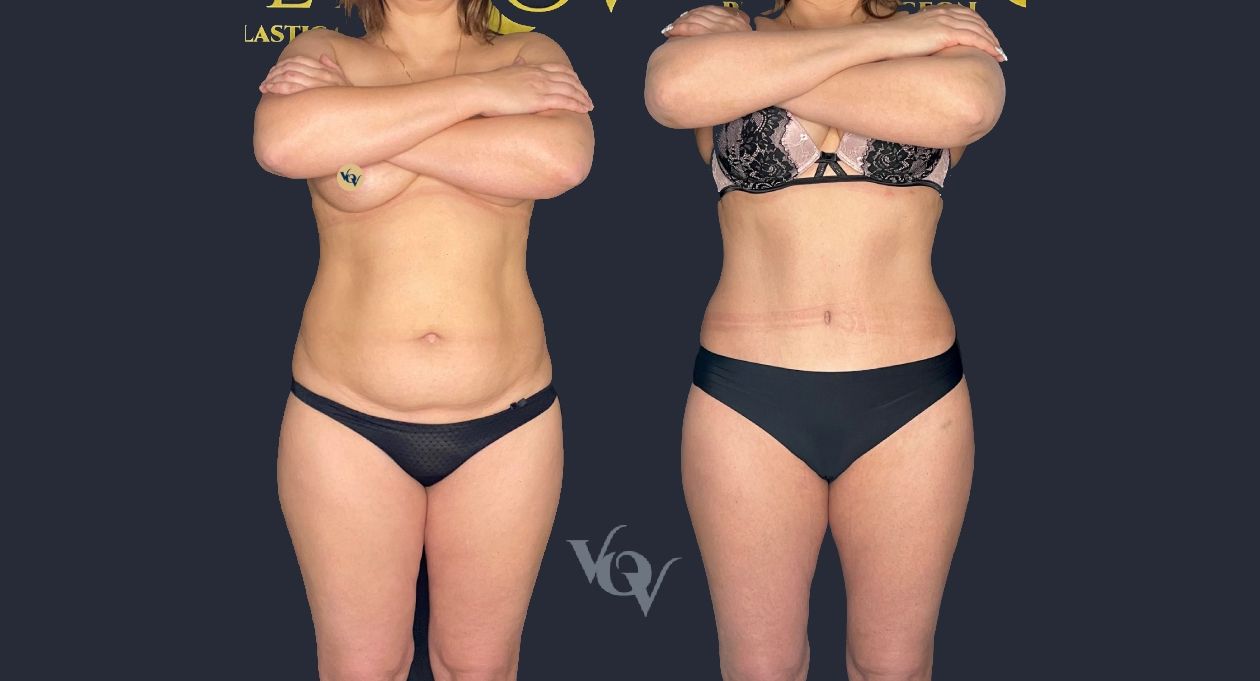 Абдоминопластика. 6 месяцев после операции