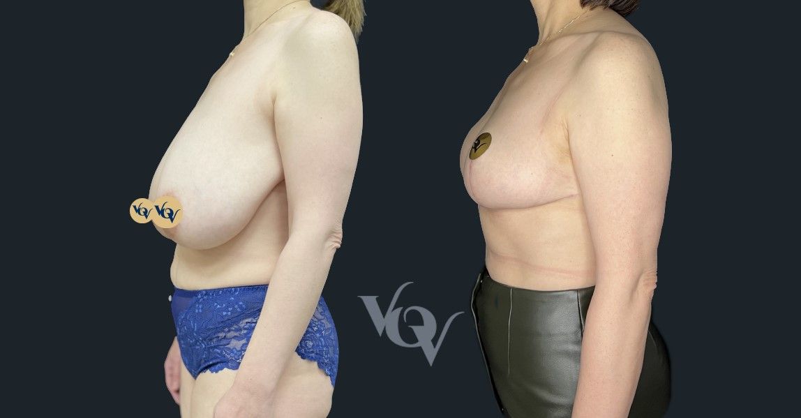 Уменьшение груди. 2 месяца после операции 