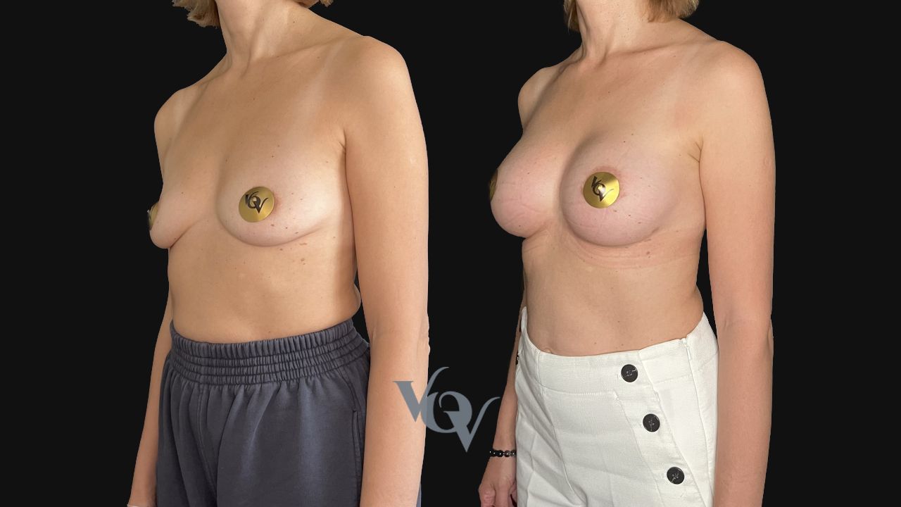 Замена имплантов. 3 месяца после операции