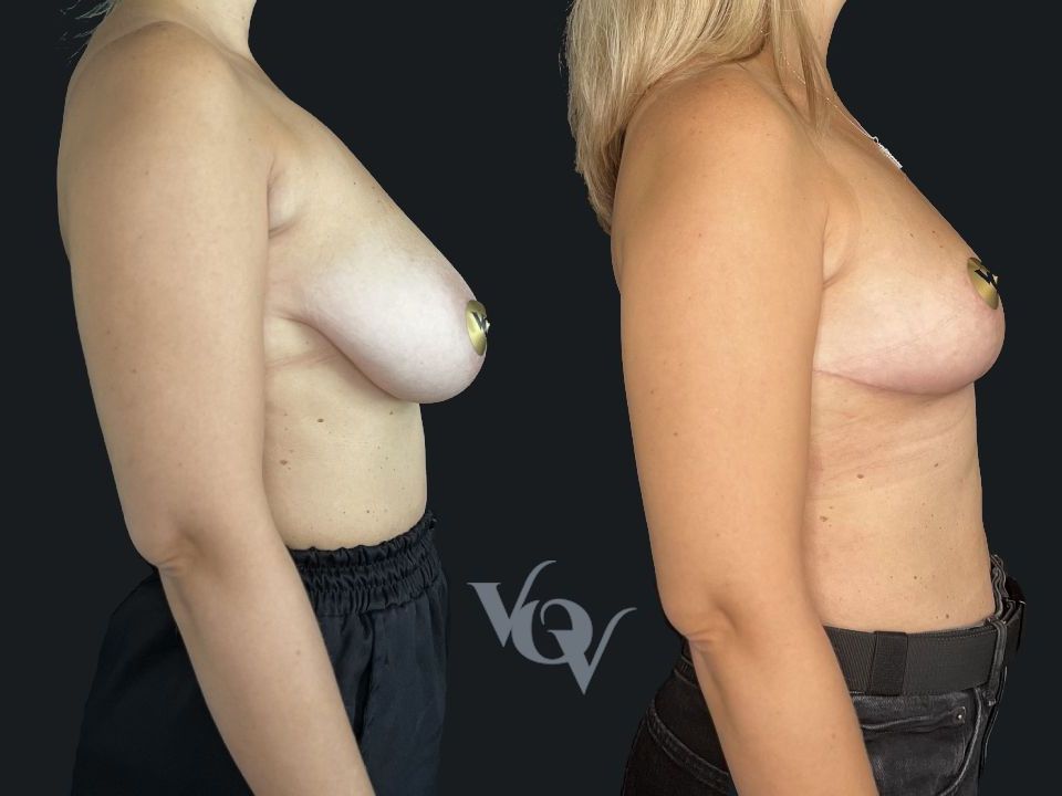 Якорная подтяжка груди. 1 месяц после операции