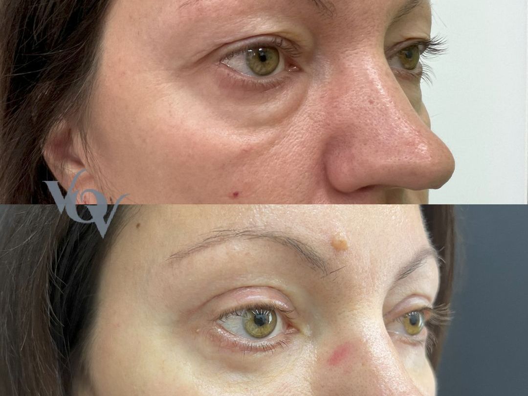 Круговая блефаропластика. 1 месяц после операции