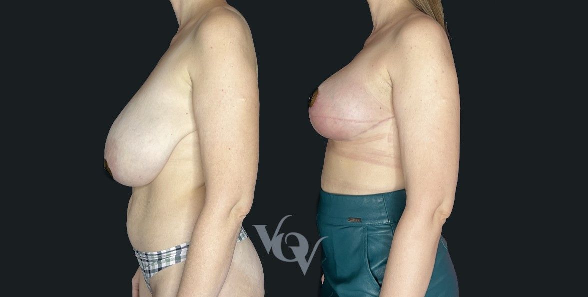 Подтяжка груди. 2,5 месяца после операции