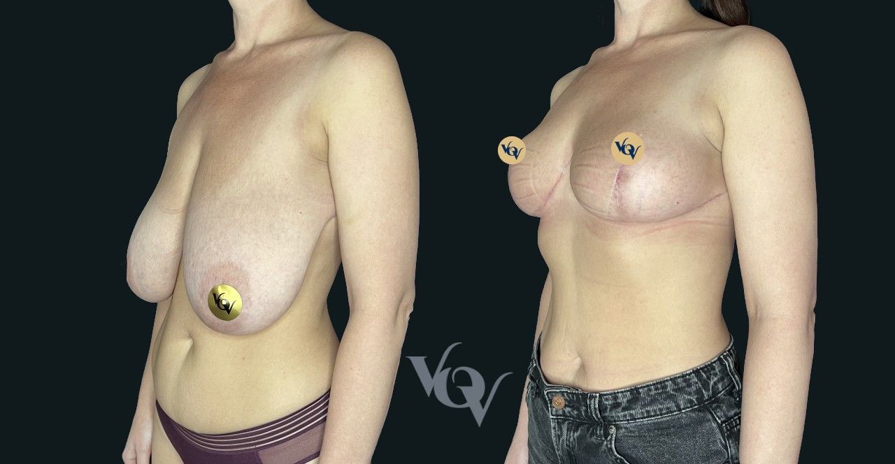 Уменьшение груди. 2 месяца после операции 