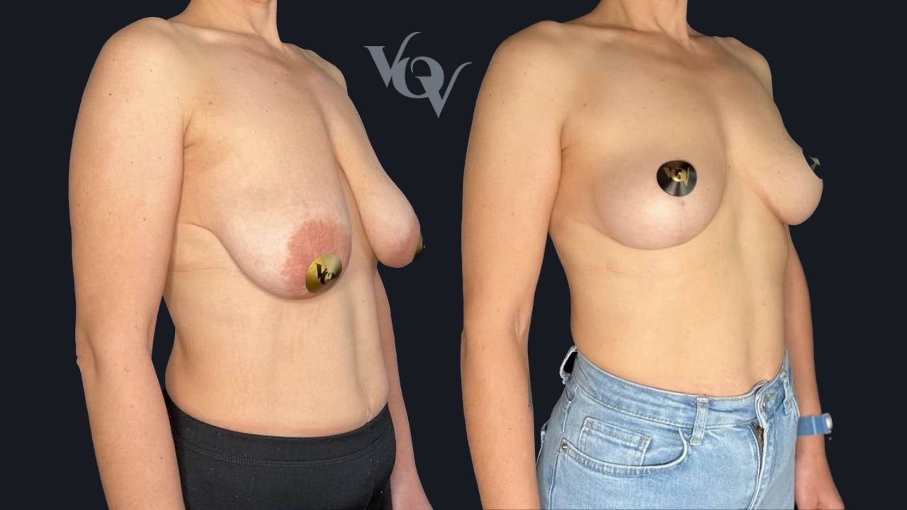 Подтяжка груди. 3 месяца после операции