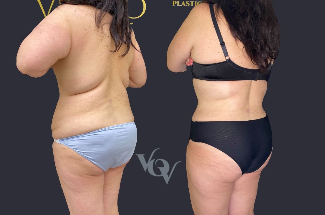 Липосакция спины. 2 месяца после операции