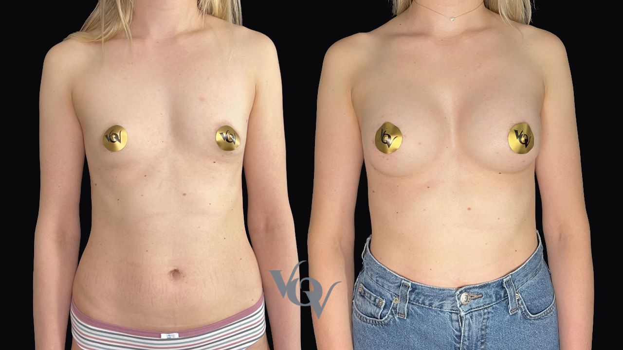 Замена имплантов. 3 месяца после операции