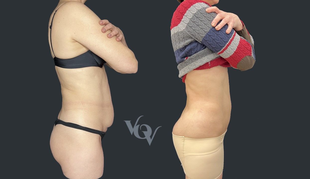 Миниабдоминопластика. 3 месяца после операции