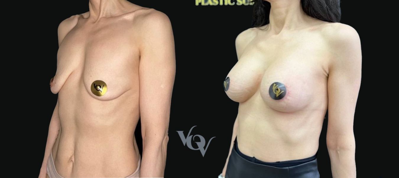 Замена имплантов. 1 месяц после операции