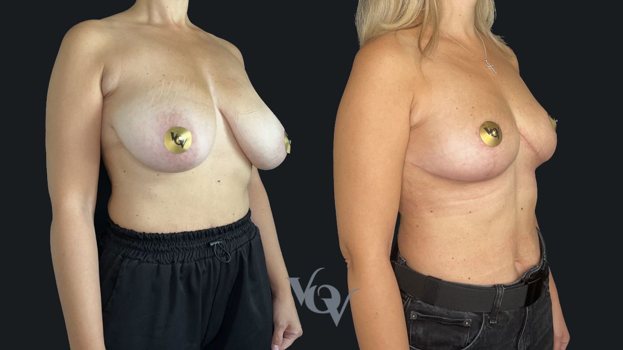 Подтяжка груди. 1 месяц после операции