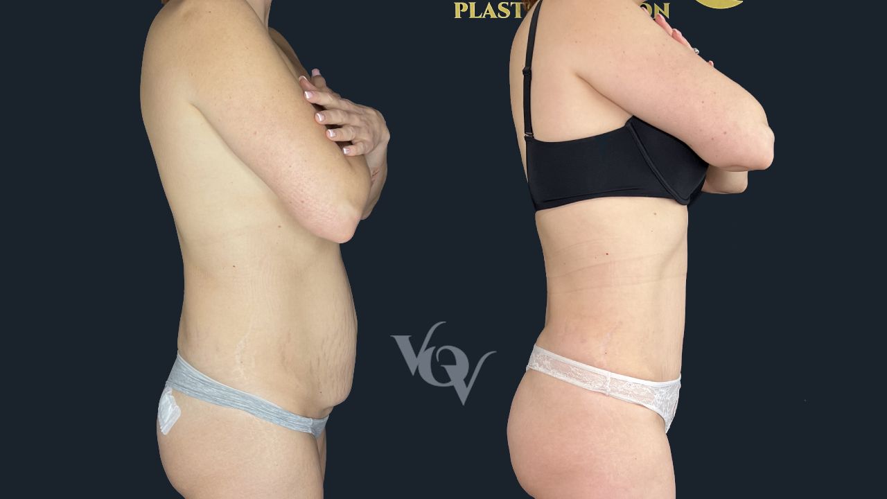 Абдоминопластика. 5 месяцев после операции