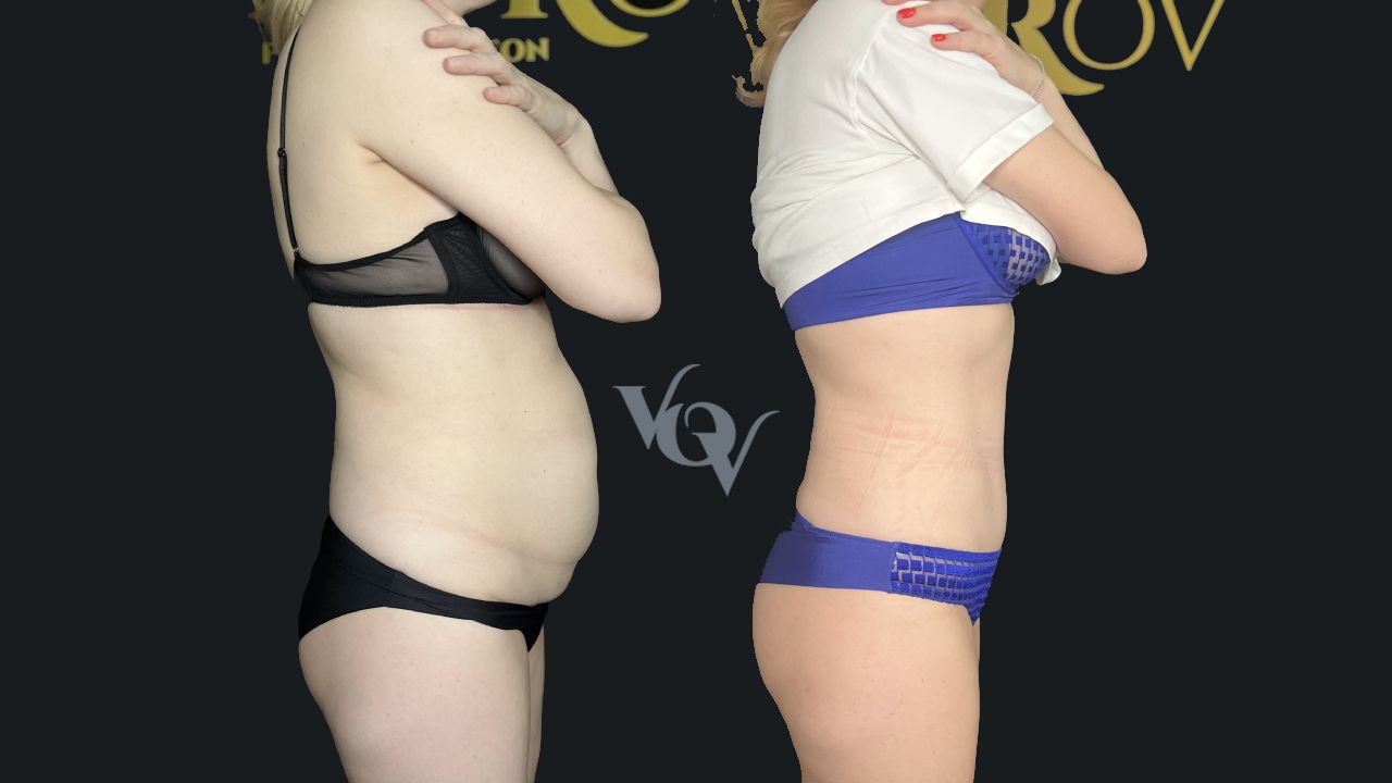 Абдоминопластика. 3 месяца после операции