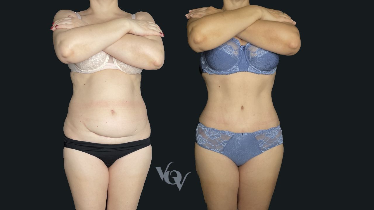 Абдоминопластика. 4 месяца после операции