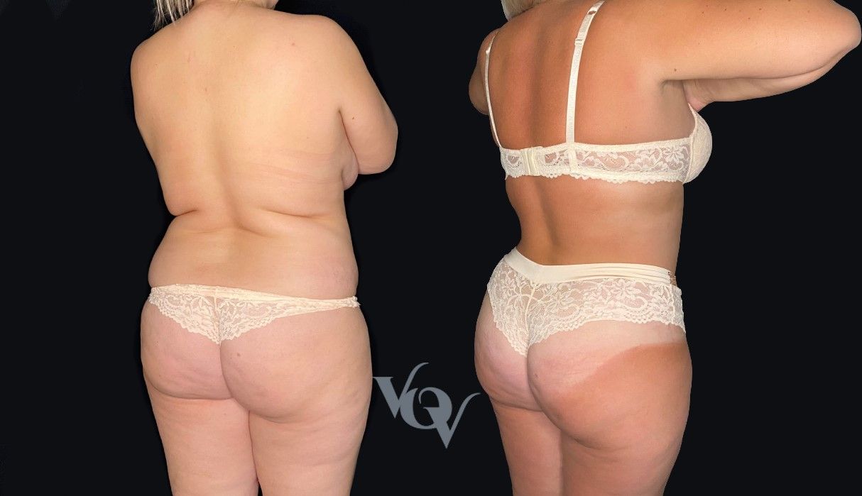 Липосакция спины. 4 месяца после операции