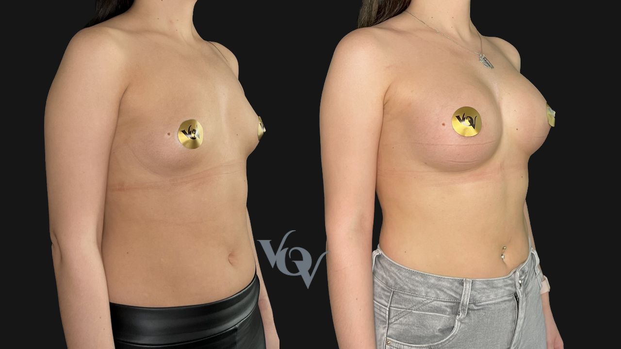 Замена имплантов. 2 месяца после операции