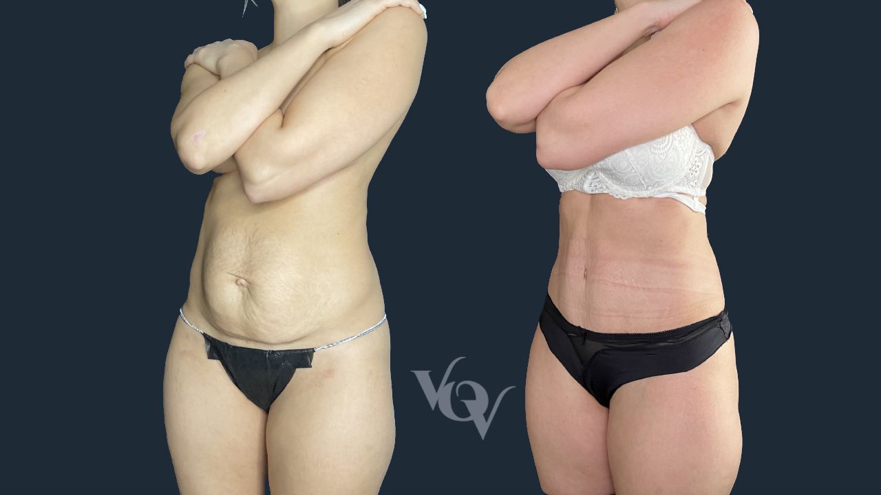 Абдоминопластика. 4 месяца после операции